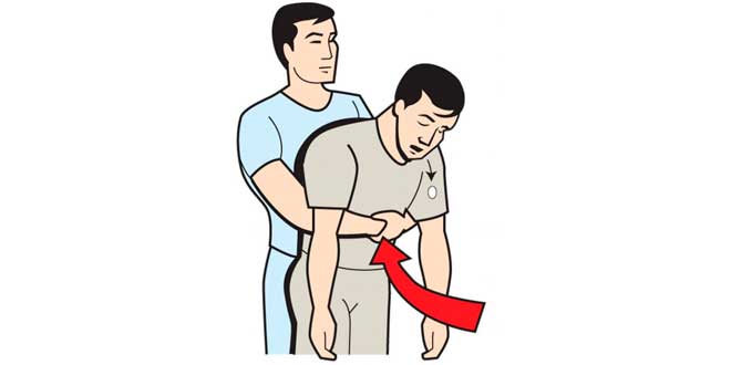 Maniobra de Heimlich